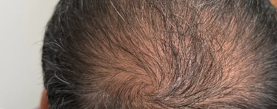 Coronilla antes del tratamiento, con poca densidad